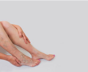 varicose vein removal clinic Adelaide